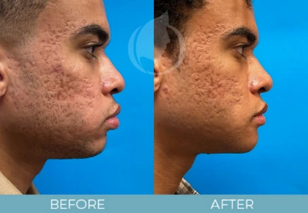 Chin Lift before and after