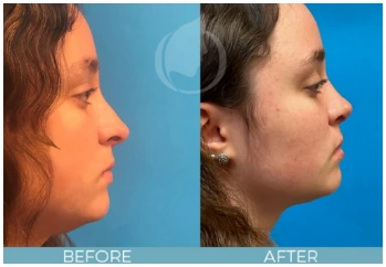 Rhinoplasty before and after