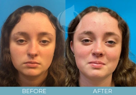 Rhinoplasty before and after