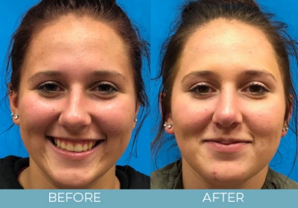 Rhinoplasty before and after