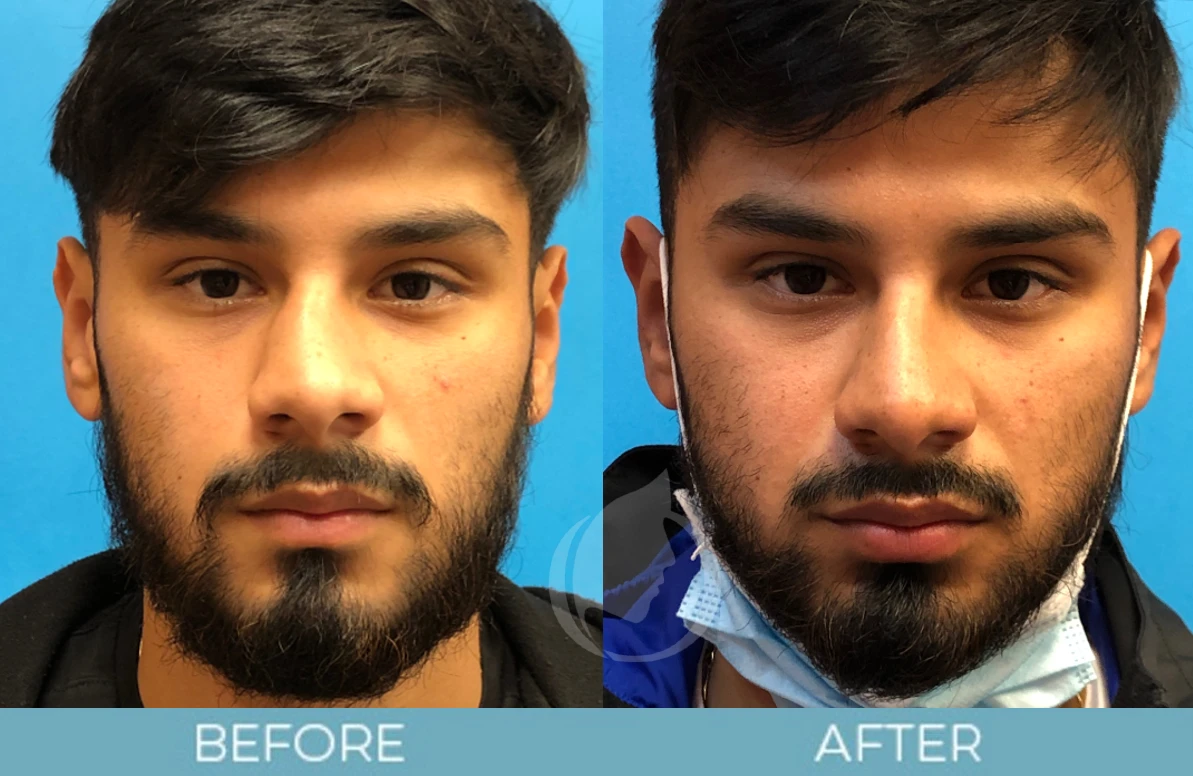 male rhinoplasty patient in Atlanta